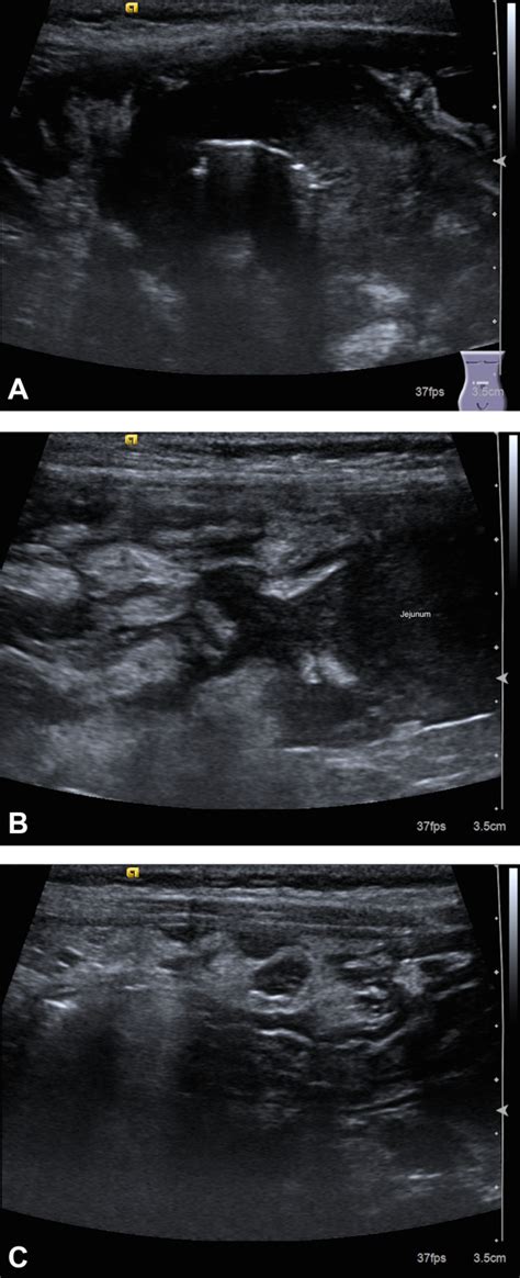 Sonographic Features Of Peritoneal Lymphomatosis In 4 Cats Morgan