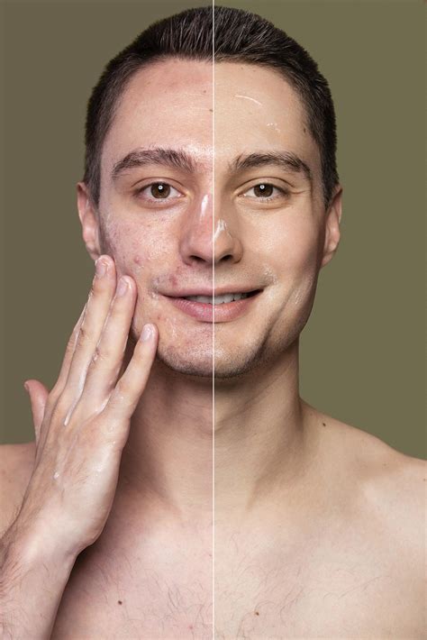 Treatment To Improve Mens Skin Pigmentation