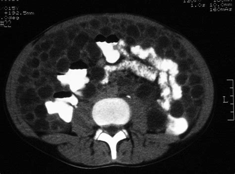 Ct Scan Showing Hydatid Cyst In The Abdominal Cavity Care