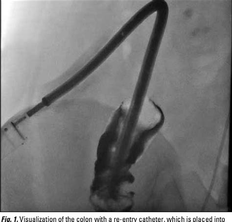 Figure 1 From Colon Perforation During Percutaneous Nephrolithotomy And