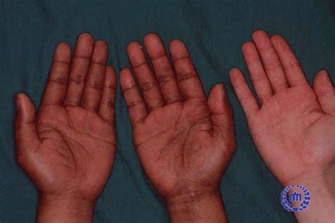 1 Hyperpigmentation Of The Palms A Common Finding In Addisons