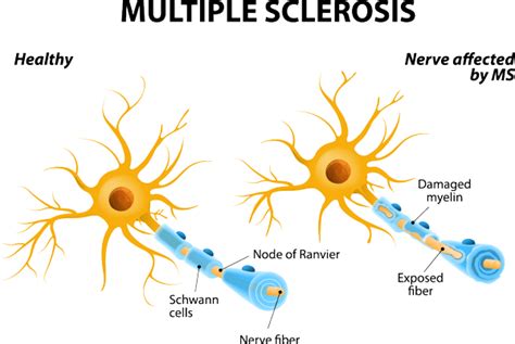 This process results in the de… Living with multiple sclerosis: One woman's valiant battle ...