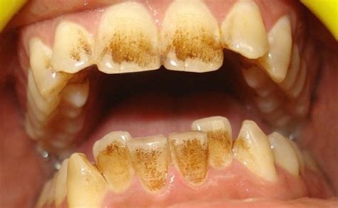 I have two front teeth that are bonded and have a little stain on them. I drink tea all day. Will this stain my teeth? - Quora