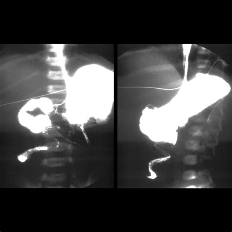 Malrotation With Midgut Volvulus Pediatric Radiology Reference