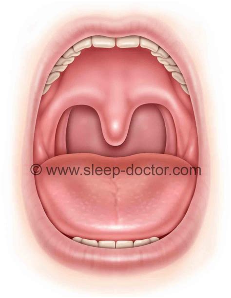 Palate Surgery With Small Or Absent Tonsils New Research And A Key To