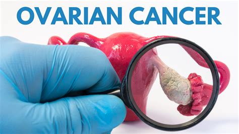 ovarian cancer ovarian cancer precision medicine treating ovarian cancer if you ve been