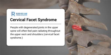 Cervical Facet Syndrome Njs Top Orthopedic Spine And Pain Management