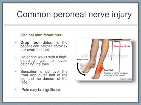 Peripheral Nerve Injuries