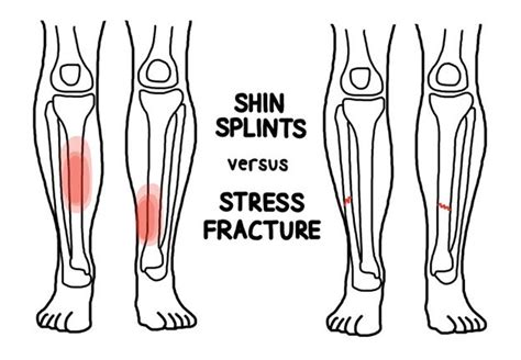 Stress Fracture Or Shin Splints How To Tell The Difference Injury