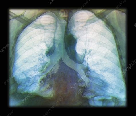 Kaposis Sarcoma Of The Lung Ct Scan Stock Image C0132193