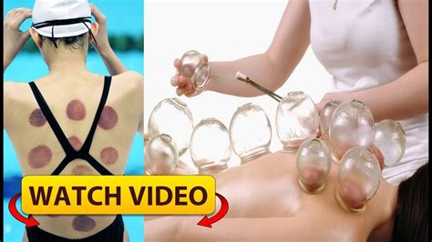Amazing Benefits Of Cupping Therapy Everyone Should Know Youtube