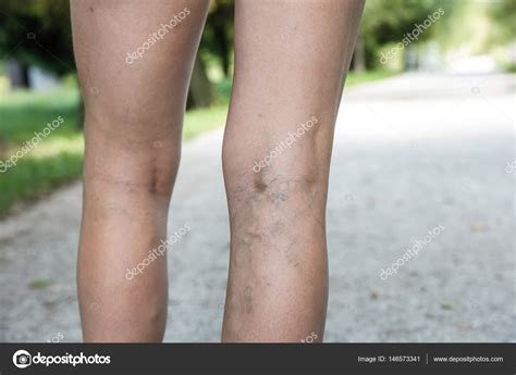 Varices douloureuses et veines d'araignée sur les jambes des femmes ...
