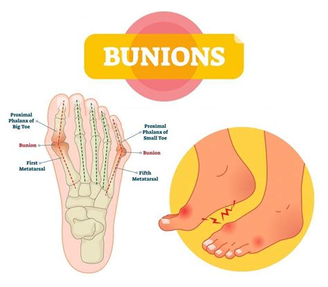 Bunions Diagnosis And Treatment Eugene Stautberg Md General Orthopedic Surgeon
