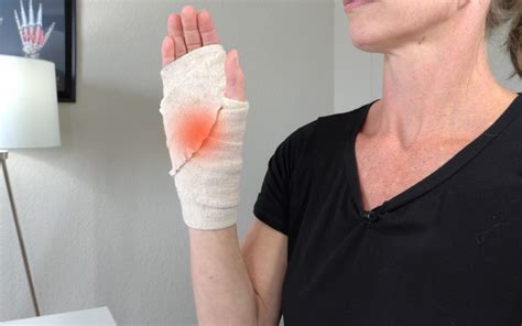 How To Prepare For Carpal Tunnel Surgery Virtual Hand Care