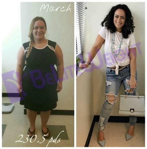 15 Wonderful Vsg Before And After Sleeve Weight Loss Surgery Best
