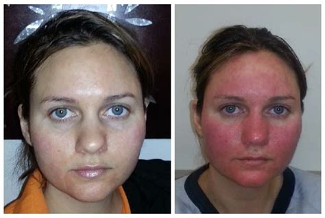 Severe Mirvaso Rebound Redness Dermatitis Medicamentosa Rosacea