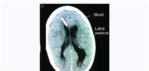 Grossly Dilated Lift Lateral Ventricle Third Ventricle In Normal Size