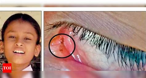 doctors stunned after dead ants seen coming out of girl s eyes bengaluru news times of india
