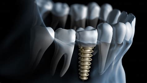 Best dental implant treatments in india. Everything You Need to Know About Getting the Best Dental ...