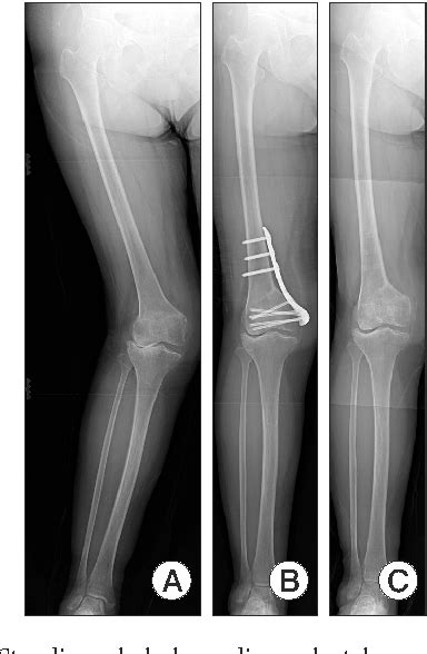 Figure 3 From Closed Wedge Distal Femoral Osteotomy With A Polyaxial