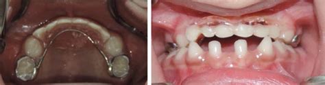 Modified Fixed Nance Appliance With Artificial Anterior Teeth
