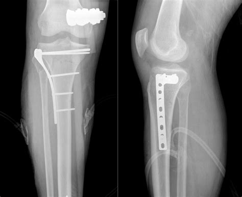 Ap Radiograph Of A Medial Tibial Plateau Fracture Tre
