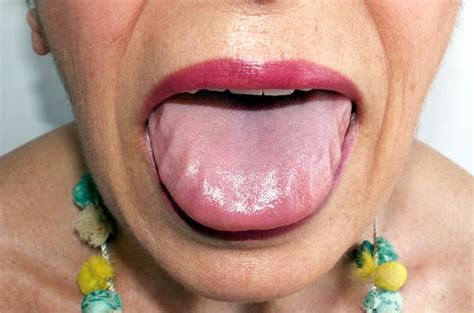 Tongue Amyloidosis