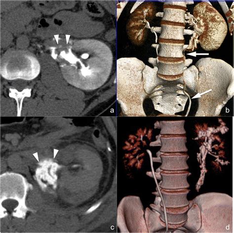 Laceration Of The Ureteropelvic Junction A And B And Avulsion Of The Download Scientific