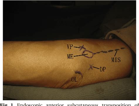 Figure 1 From Endoscopic Anterior Subcutaneous Transposition Of The