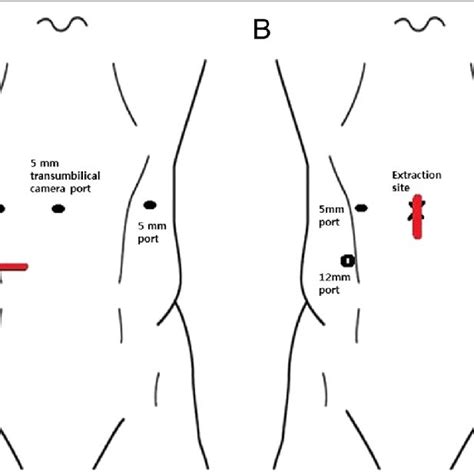 A Port Placement For Patients Who Underwent Laparoscopic Resection