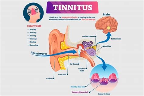 Tinnitus Causes Research And Treatments Ear Wax Removal
