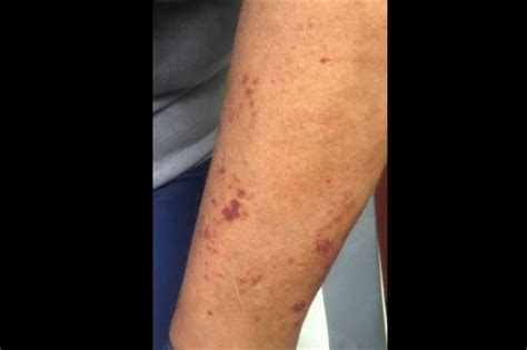 Clinical Challenge Dark Spots On The Arms Mpr