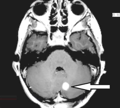 Learning Radiology Cerebellar Pilocytic Astrocytoma