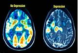 Photos of Depression Brain