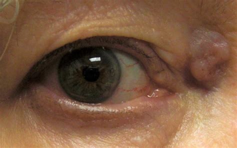 Identifying And Treating Eyelid Skin Cancer Cancerous