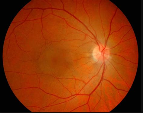 What Is Central Serous Retinopathy Fort Lauderdale Eye Institute