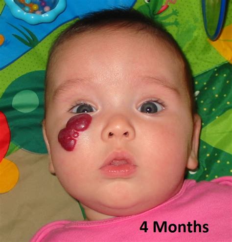 Cherry angiomas get their reddish appearance due to the collection of small blood vessels inside of them. Do you know what a Hemangioma is? - Twiniversity