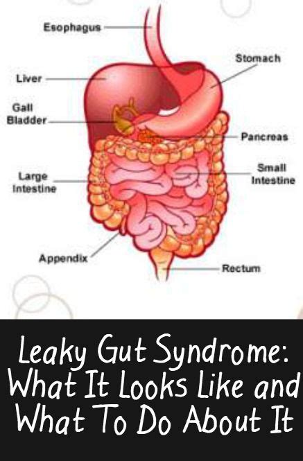Leaky Gut Syndrome What It Looks Like And What To Do About It Leaky
