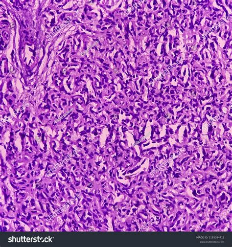 Vascular Tumor Scalp Biopsy Intramuscular Hemangioma Stock Photo