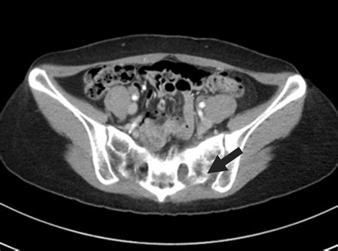 Pelvis Computed Tomography Showing Ill Defined Sclerosis Or Mottled