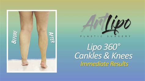 Lipo 360° Legs Cankles And Knees Liposuction Immediate Results