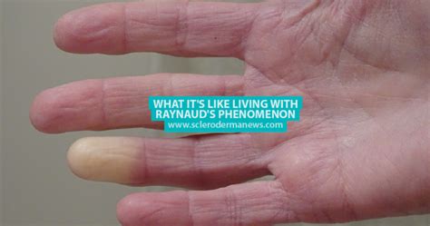 What Its Like Living With Raynauds Phenomenon Scleroderma News