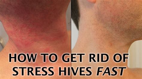 Hives Caused By Stress Or Anxiety