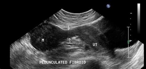 What Do Fibroids Look Like On Ultrasound