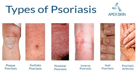Why Is There No Cure For Psoriasis Unraveling The Mystery