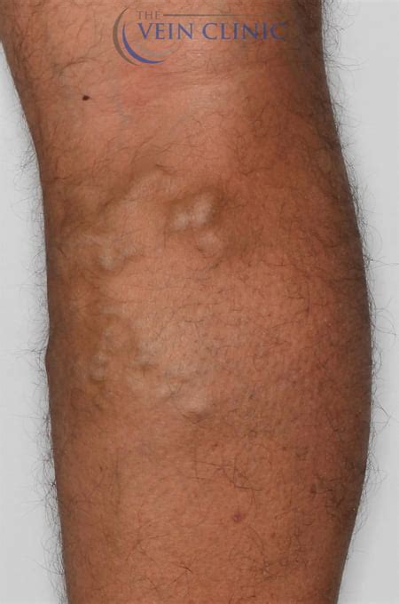 Bulging Leg Veins Treatment Vein Clinic Perth