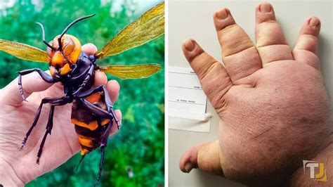 10 Worst Insect Stings Ever Youtube