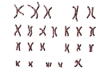 down s syndrome karyotype photograph by kateryna kon science photo library pixels