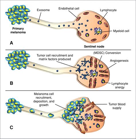 Exosomes Released By Melanoma Cells Prepare Sentinel Lymph Nodes For