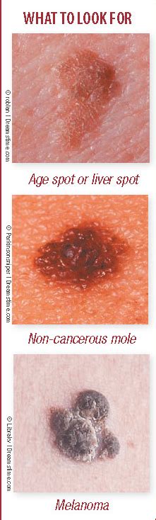 How To Tell If You Have A Skin Cancer Spot How To Tell If Moles Are